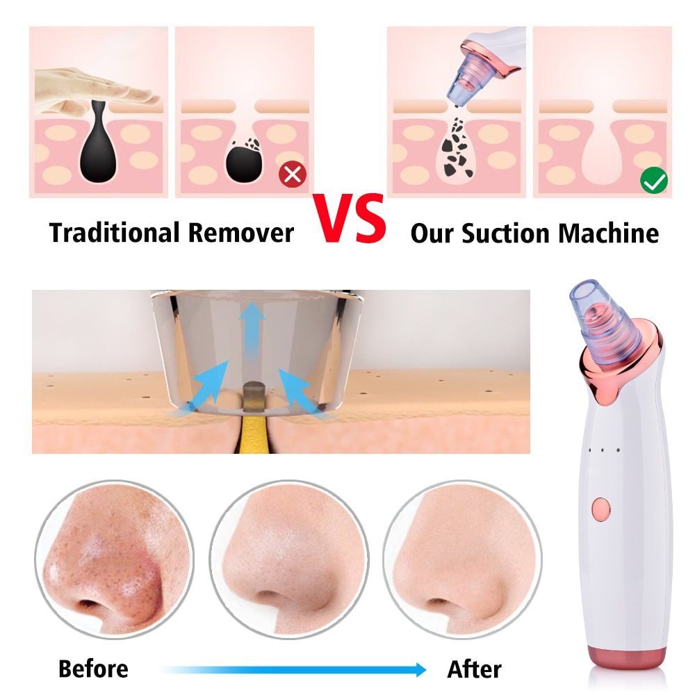 LuxuryGlow Electric Blackhead Remover – Deep Pore Cleaner with 5 Suction Levels