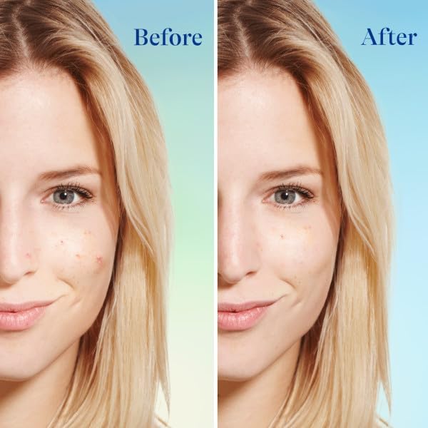 Differin Acne Face Wash with 5% Benzoyl Peroxide – Daily Deep Cleanser for Sensitive, Acne-Prone Skin, 4oz