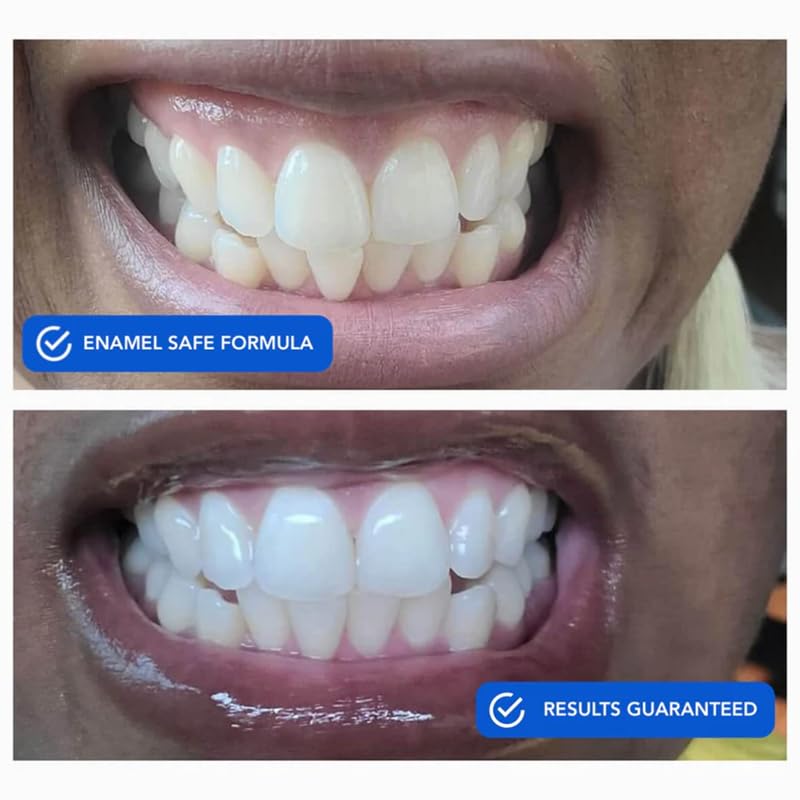 SNOW Diamond Dissolving Teeth Whitening Strips - Gentle & Enamel Safe White Strips for Teeth Whitening, at-Home Dental Hygiene & Tooth Care with Hydroxyapatite - 14 Ct