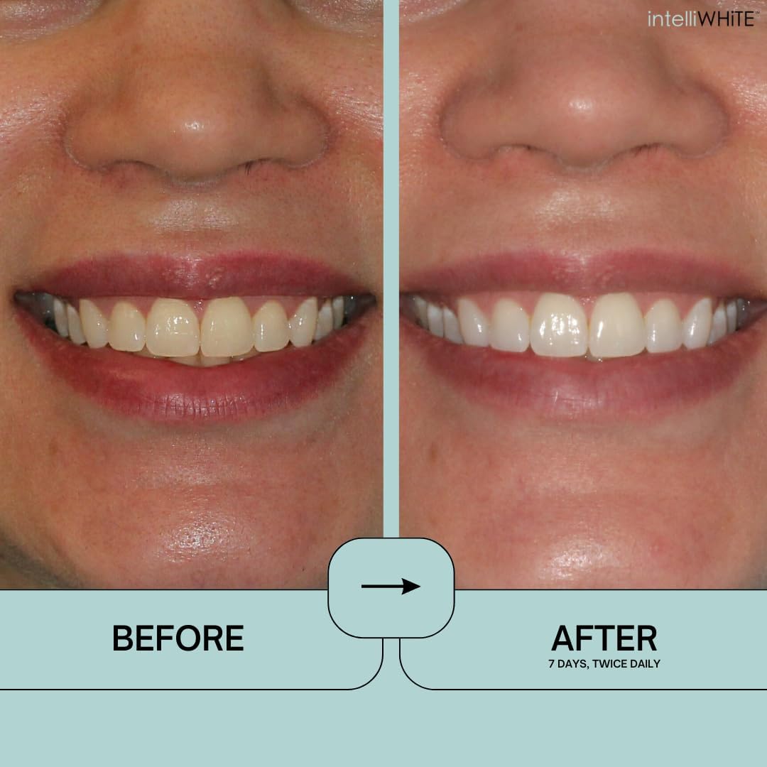 Prostrips Teeth Whitening – 12 Shades Whiter, Enamel-Safe, No Sensitivity, 28 Gentle Strips with Minerals