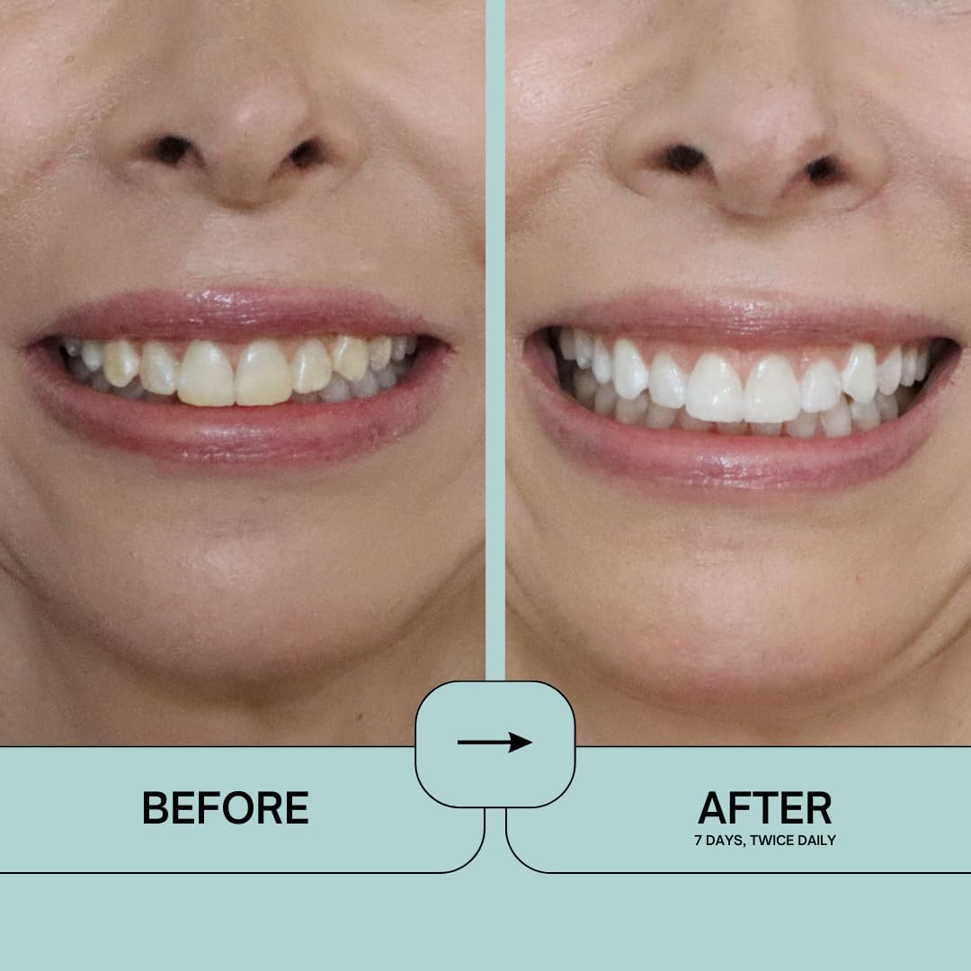 Prostrips Teeth Whitening – 12 Shades Whiter, Enamel-Safe, No Sensitivity, 28 Gentle Strips with Minerals