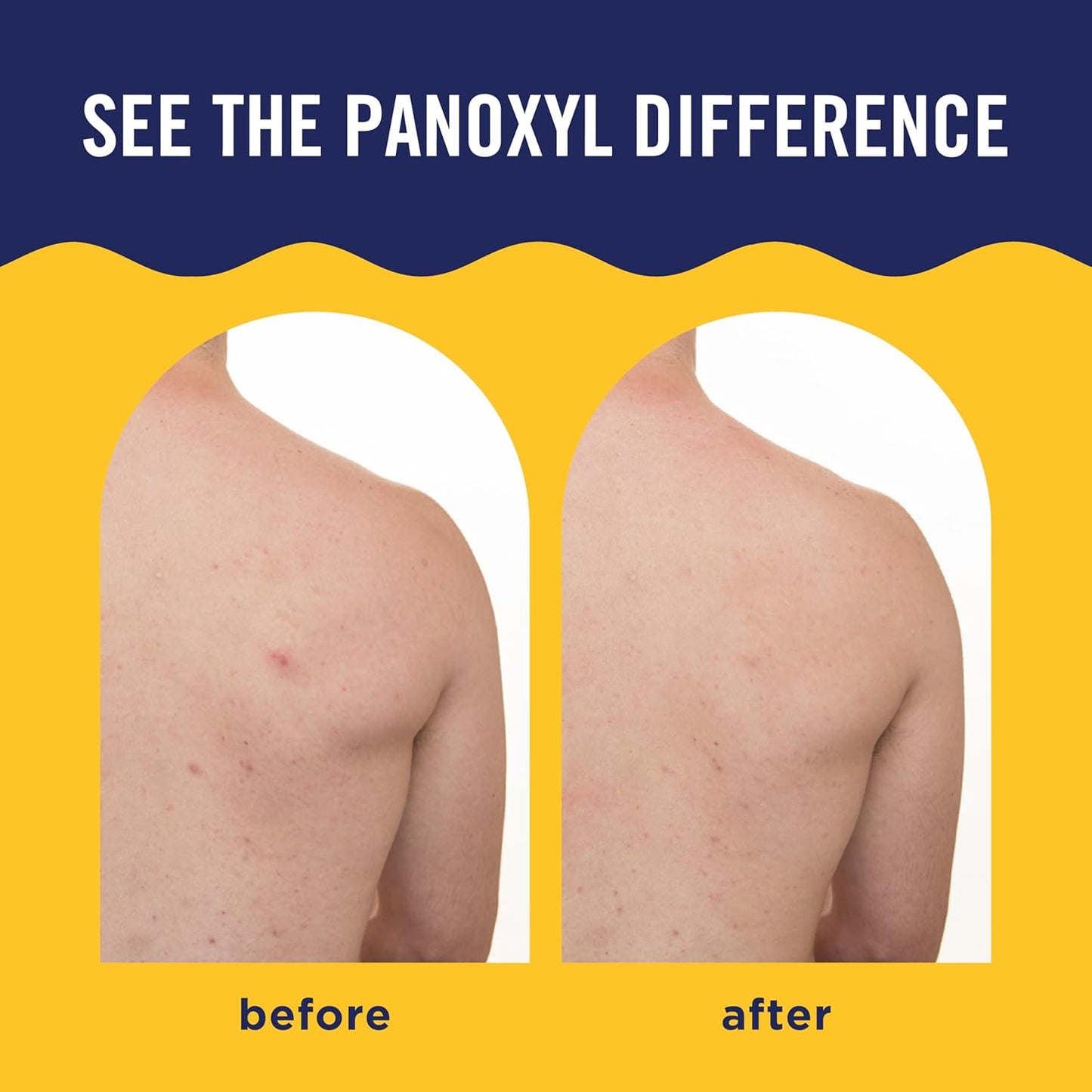 PanOxyl Acne Banishing Body Spray with 2% Salicylic Acid | 360° Nozzle, Niacinamide & Vitamin C, 6 Oz