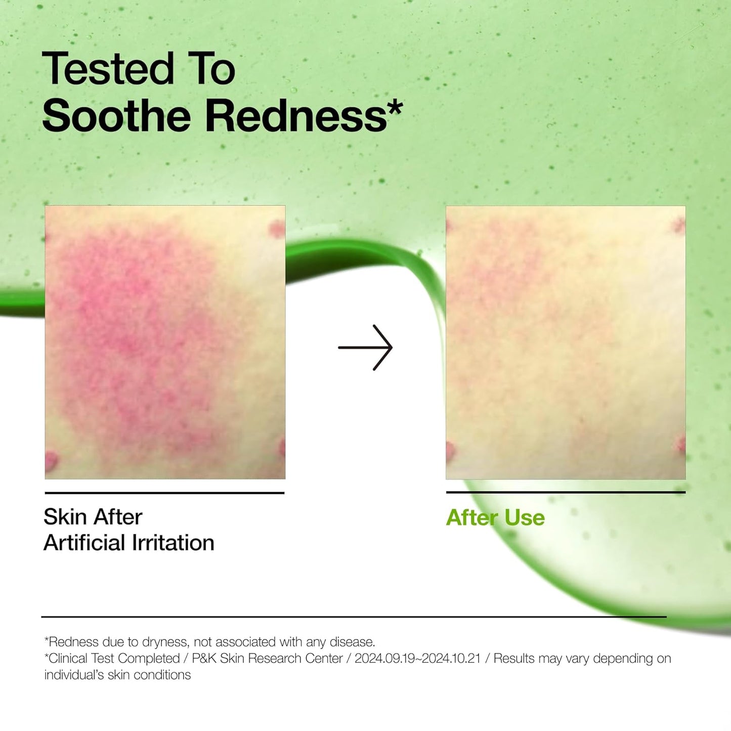Anua Azelaic Acid 10 Hyaluron Redness Soothing Serum | Calming, Hydrating & Brightening Face Serum for Sensitive Skin – Vegan Korean Skincare (30ml)