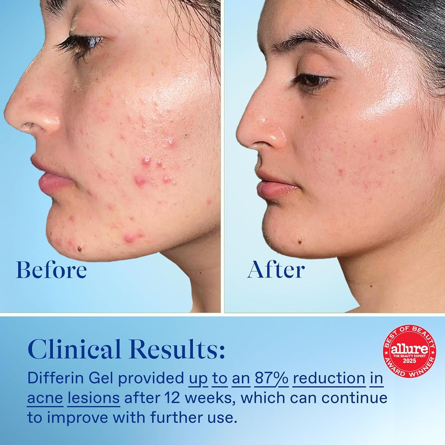 Differin Acne Treatment Gel 0.1% Adapalene – 30 Day Retinoid Face Care for Sensitive, Acne-Prone Skin – 15g Pump