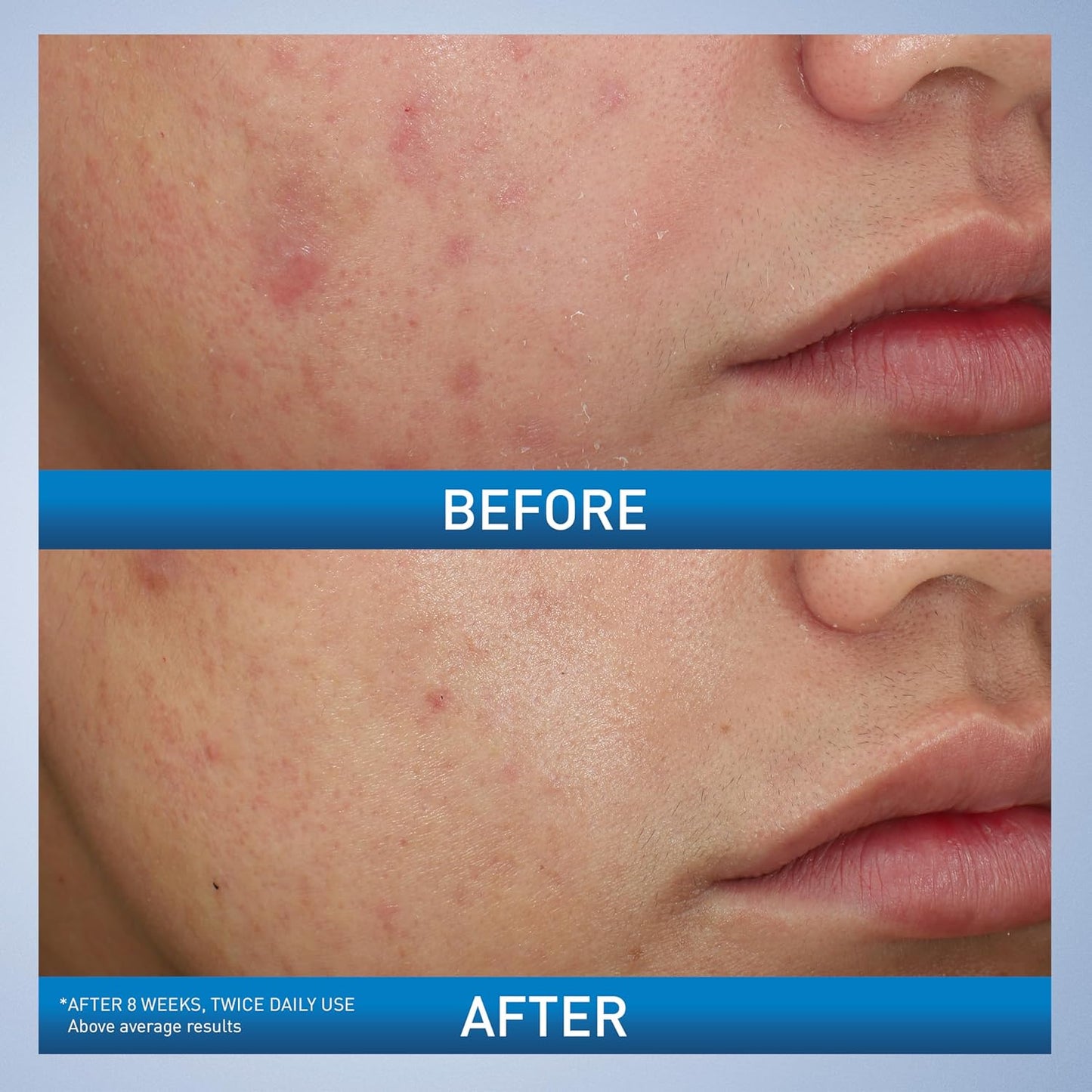 CeraVe Acne Foaming Cream Wash with 10% Benzoyl Peroxide & Niacinamide – 5oz