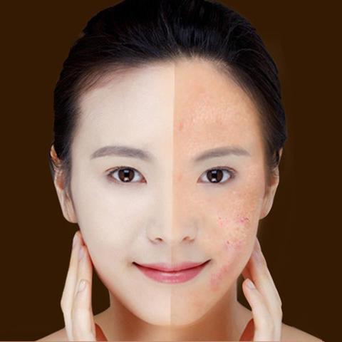 قلم ليزر الضوء الأزرق لعلاج حب الشباب من LuxuryGlow - جهاز علاج البشرة لإزالة التجاعيد والندبات