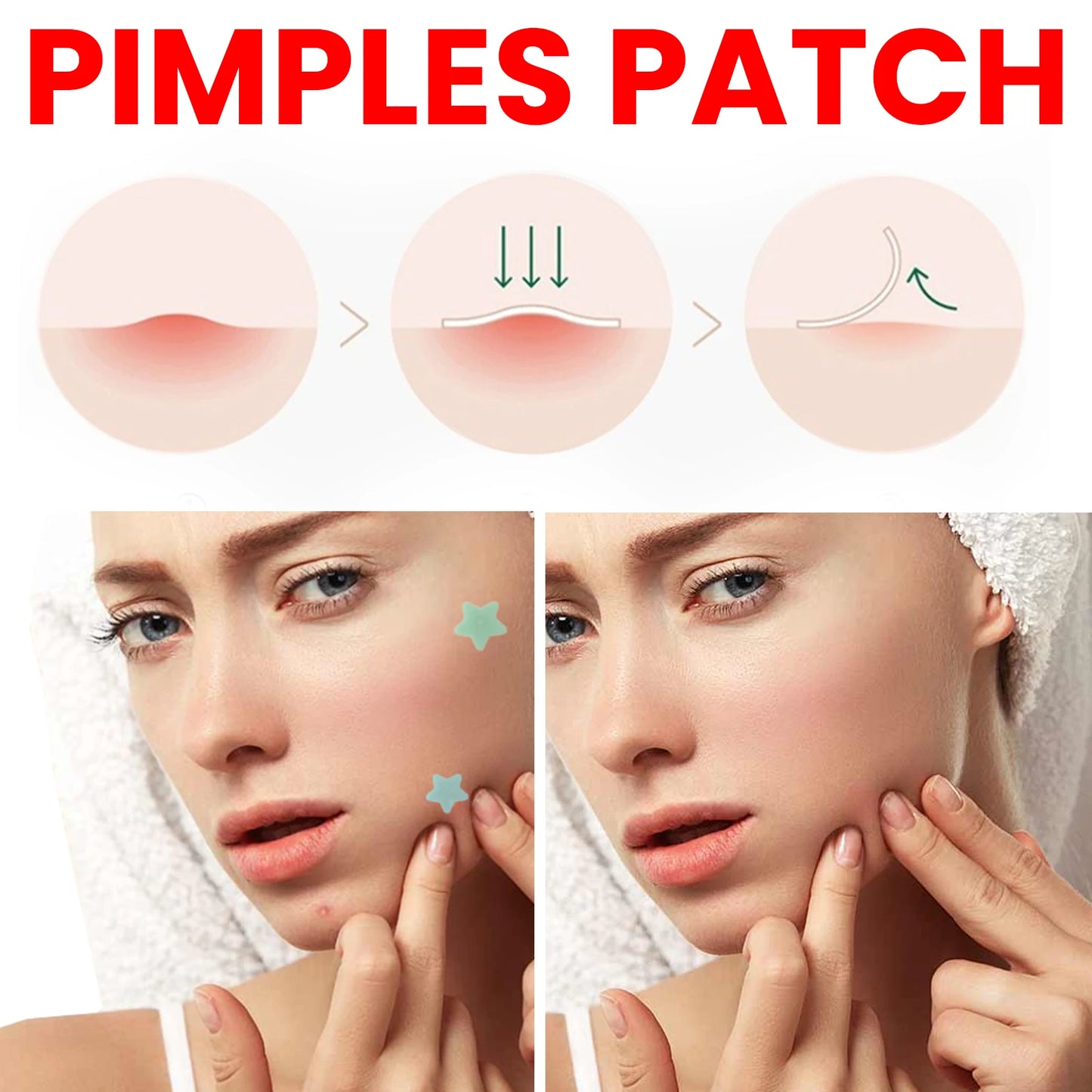 Jaysuing Acne Repair Patches – 200 Invisible Pimple Patches with Tea Tree & Witch Hazel for Fast Acne Healing & Blemish Removal