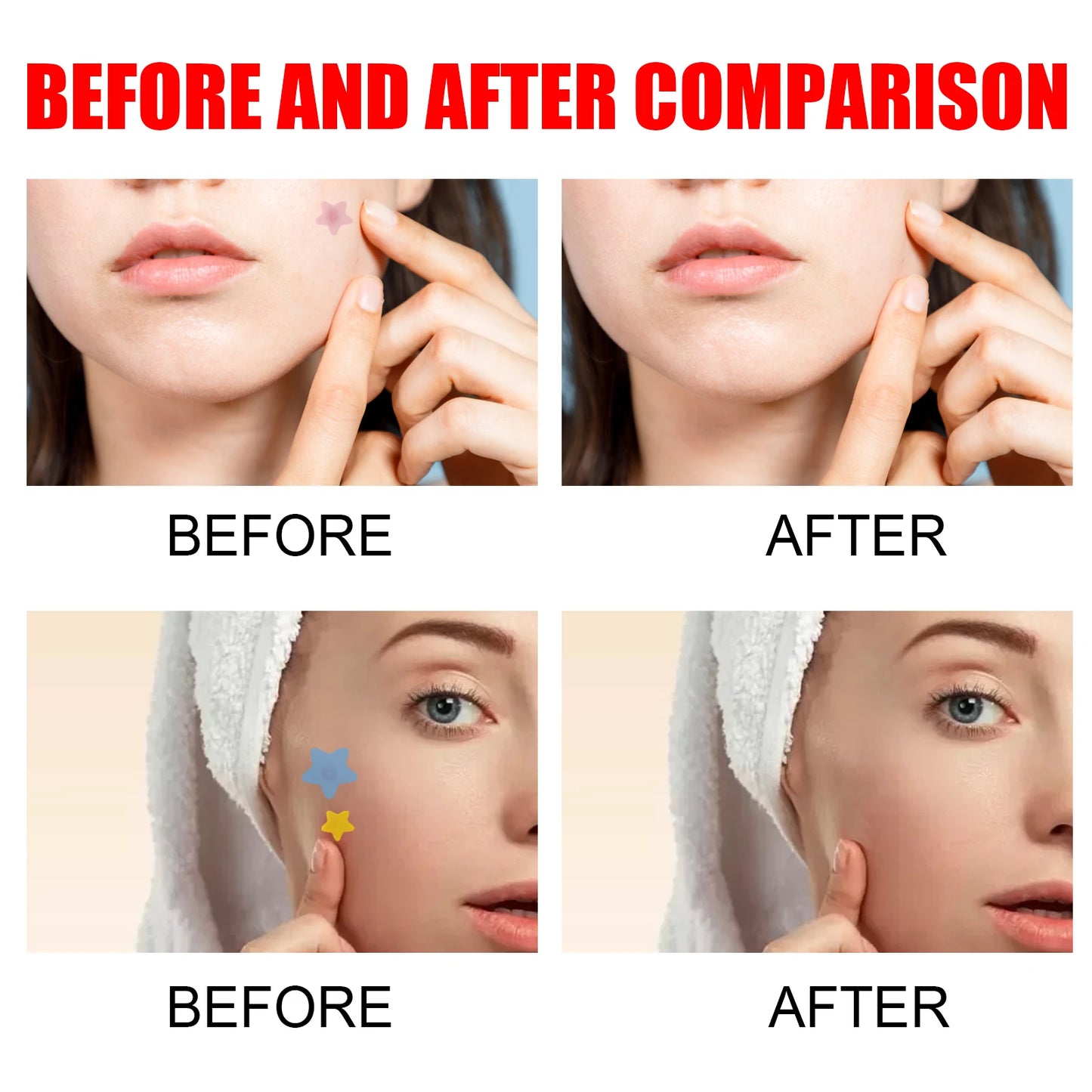 Jaysuing Acne Repair Patches – 200 Invisible Pimple Patches with Tea Tree & Witch Hazel for Fast Acne Healing & Blemish Removal