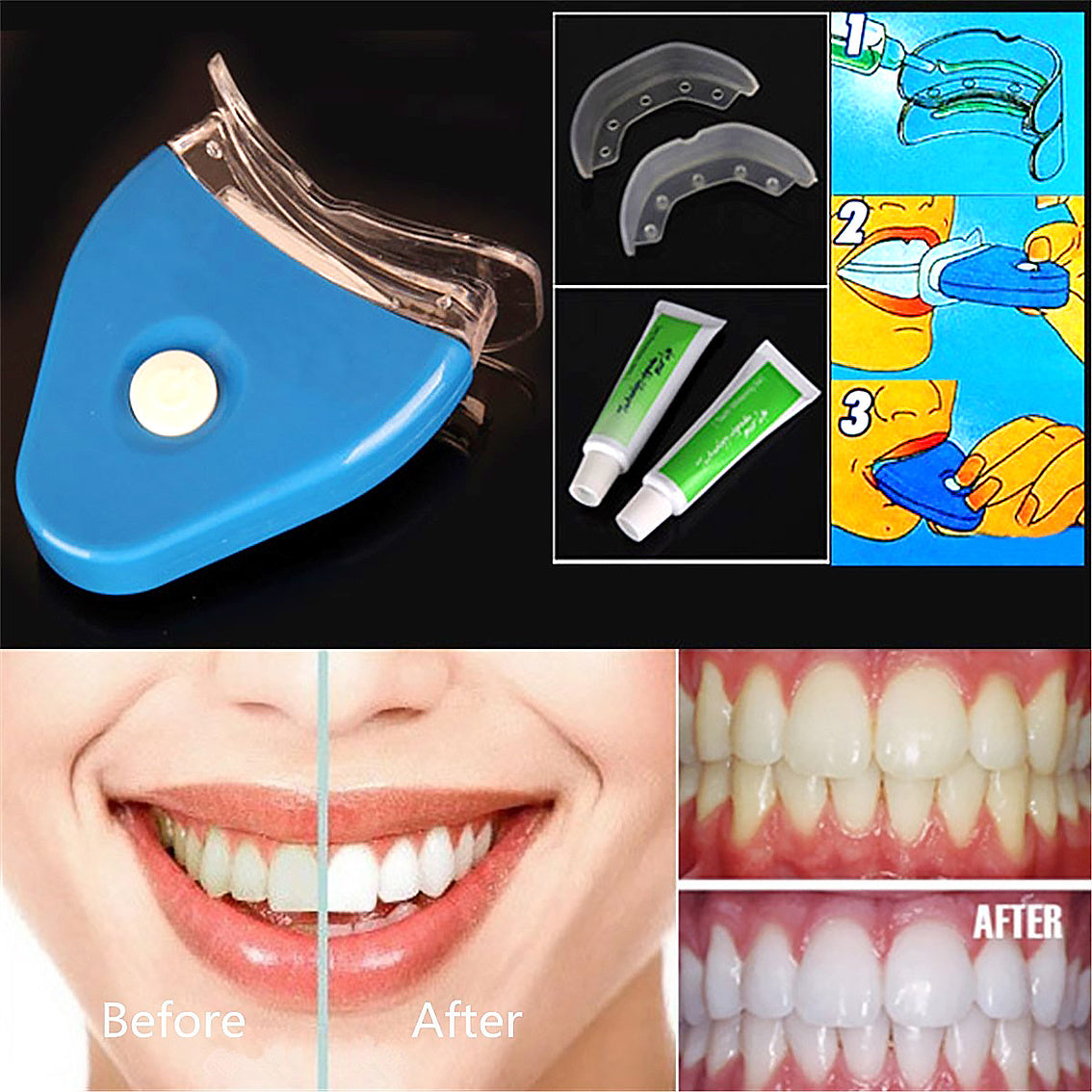 مجموعة تبييض الأسنان LuxuryGlow LED مع جل - يزيل البقع ويبيض الأسنان بسرعة