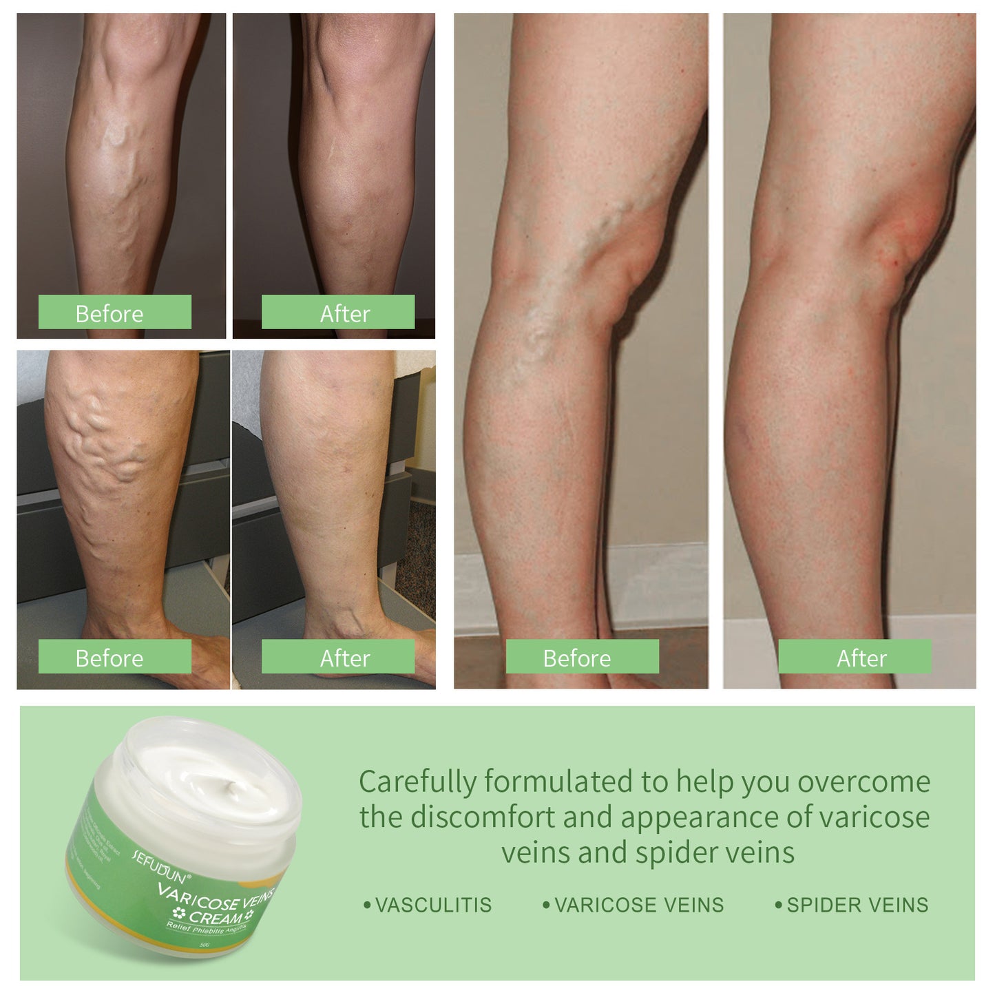 Crema para varices SEFUDUN: reduce hematomas, hinchazón y molestias venosas en las piernas (50 g)