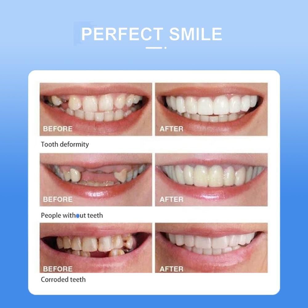 Snap-On Veneers for Men & Women – Moldable False Teeth Replacement Kit with Grinding Guard, Natural Look Temporary Dentures