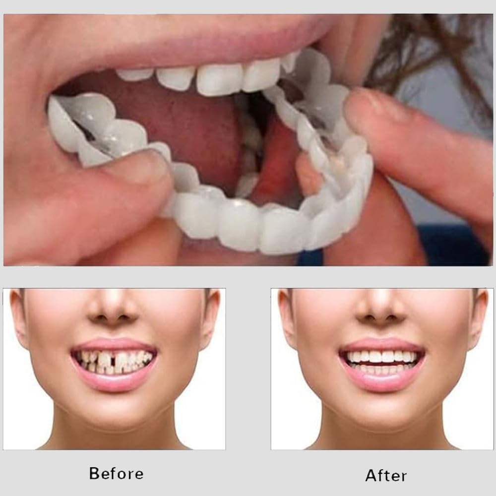 Snap-On Veneers for Men & Women – Moldable False Teeth Replacement Kit with Grinding Guard, Natural Look Temporary Dentures