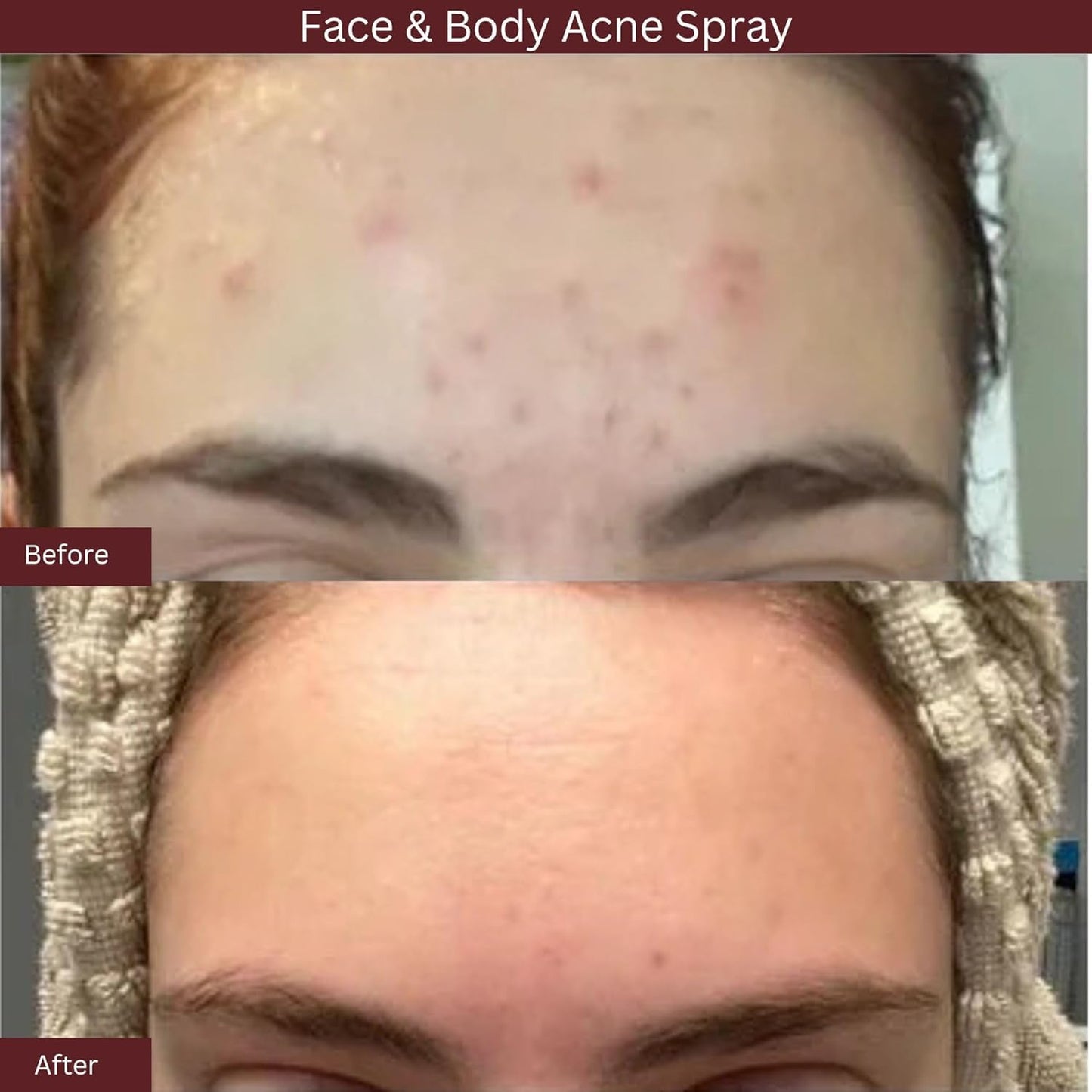 ITK 2% Salicylic Acid Acne Spray – Face & Body Treatment Mist for Bacne, Blackheads & Blemishes – Post-Workout BHA Skincare, 3.3oz