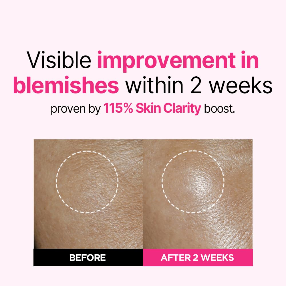 ISOI Blemish Care Up Serum – Vegan Hydrating Korean Serum for Smooth, Even-Toned & Glass Skin, 35ml
