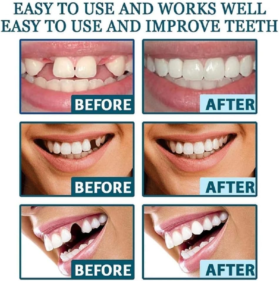 Snap-On Veneers Teeth Kit for Women & Men | Natural Tooth Replacement, Comfortable Cosmetic Dentures