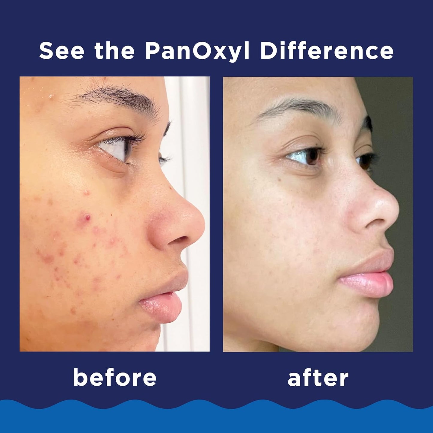 PanOxyl 10% Benzoyl Peroxide Acne Foaming Wash – Maximum Strength Antimicrobial Cleanser, 5.5 Oz