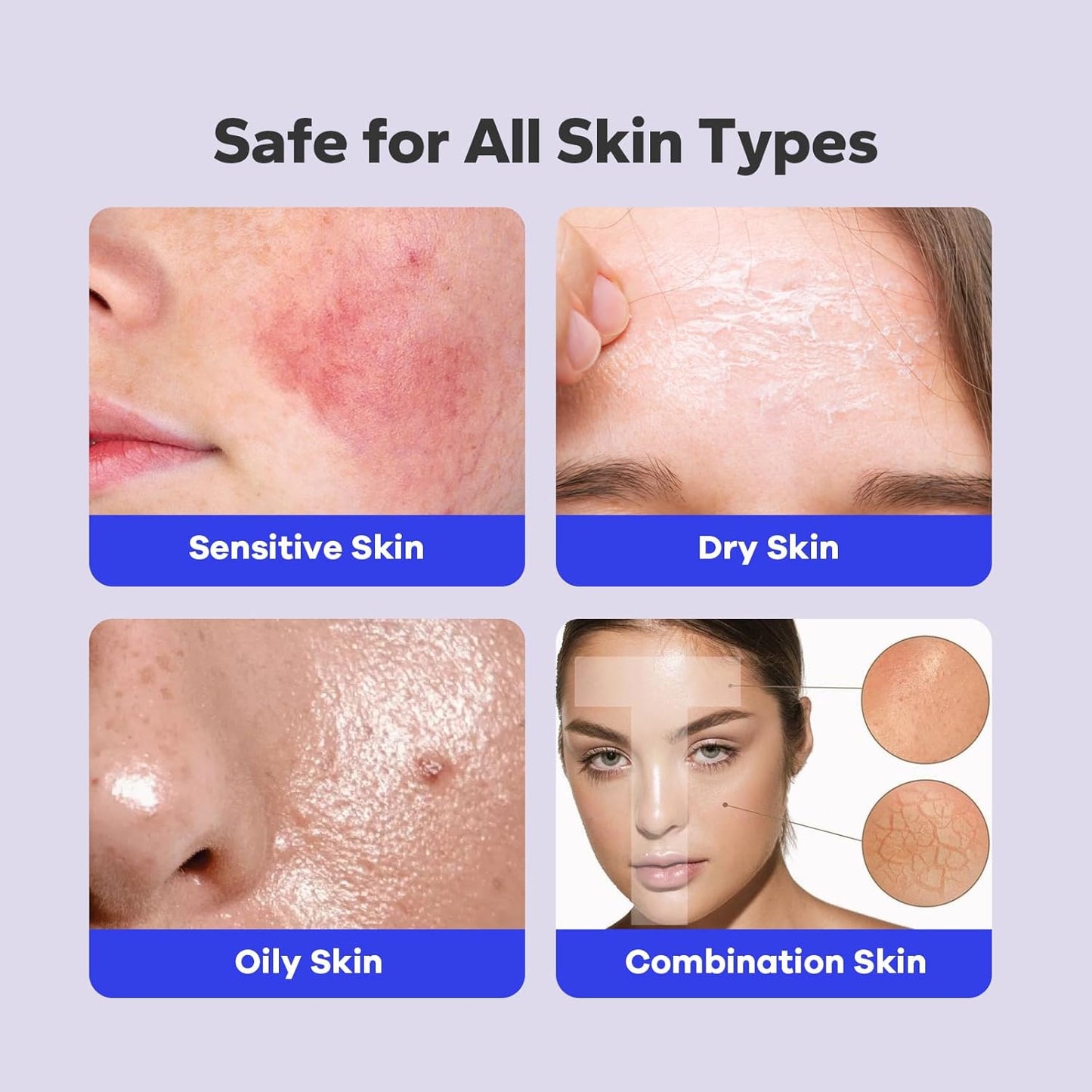 SilkyShark Salicylic Acid Body Spray 2% – Acne Treatment for Back, Chest & Face, Exfoliating Mist for Blemishes, Blackheads & Bacne, 5.07 fl oz