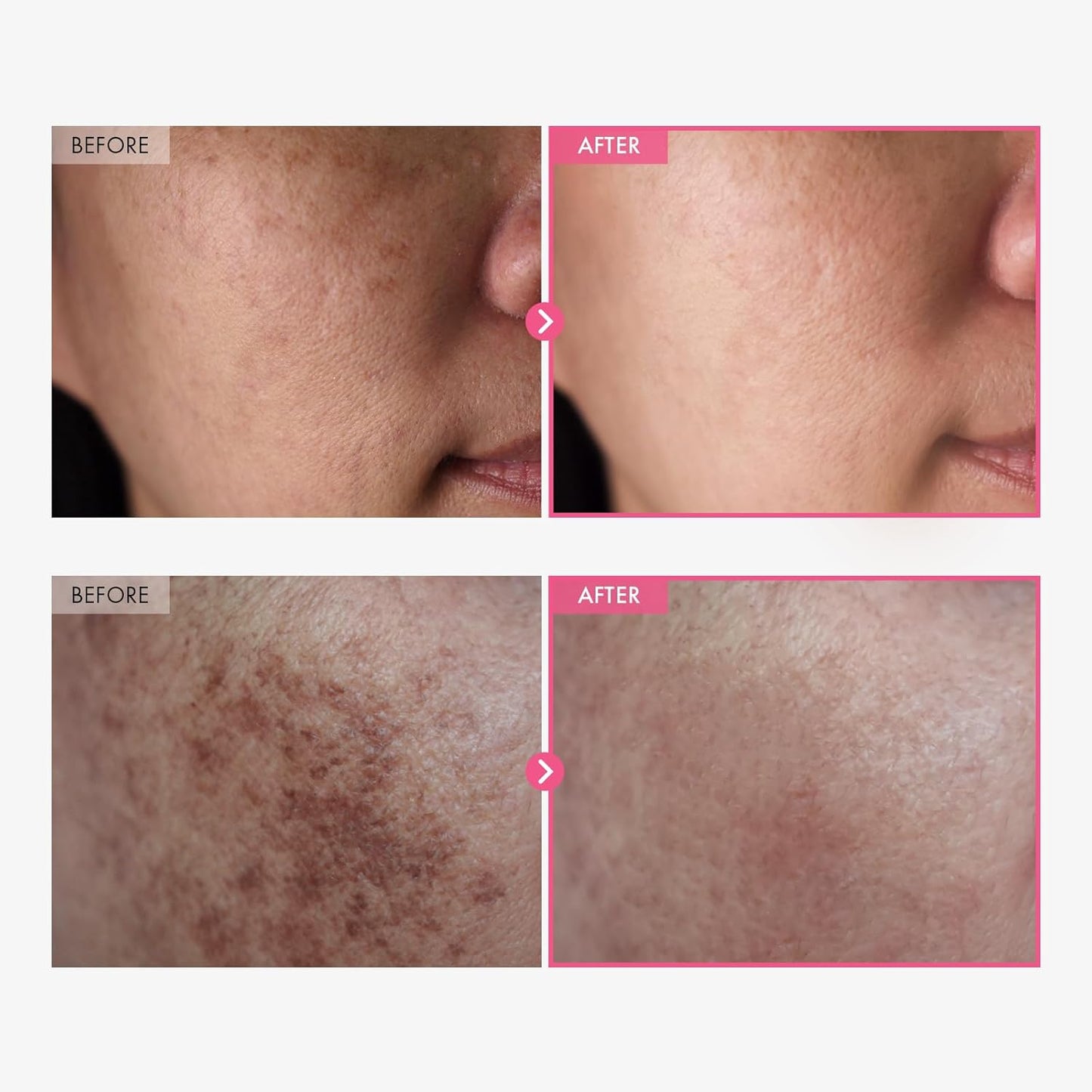 TOSOWOONG Arbutin 7% + Tranexamic Acid 4% Cream – Korean Dark Spot Corrector with Niacinamide & Glutathione for Pigmentation, Freckles & Uneven Skin Tone (50ml / 1.69 fl.oz.)