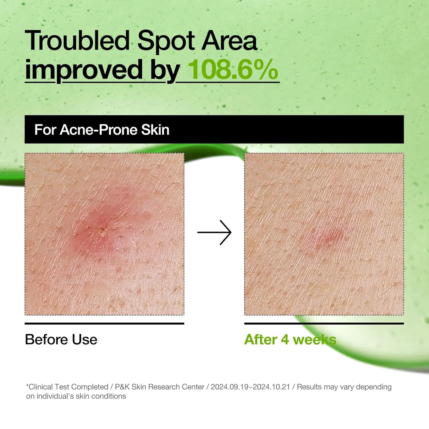 Anua Azelaic Acid 10 Hyaluron Redness Soothing Serum | Calming, Hydrating & Brightening Face Serum for Sensitive Skin – Vegan Korean Skincare (30ml)