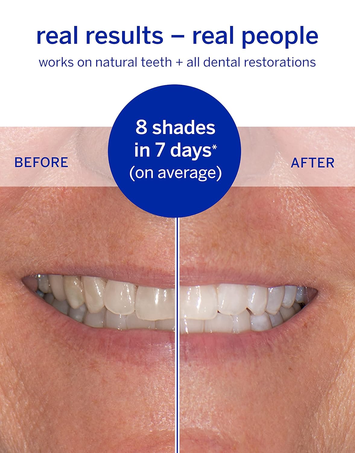 Dissolving Superstrips by Supersmile – Professional Teeth Whitening Strips | Enamel Safe, Sensitive Teeth Formula