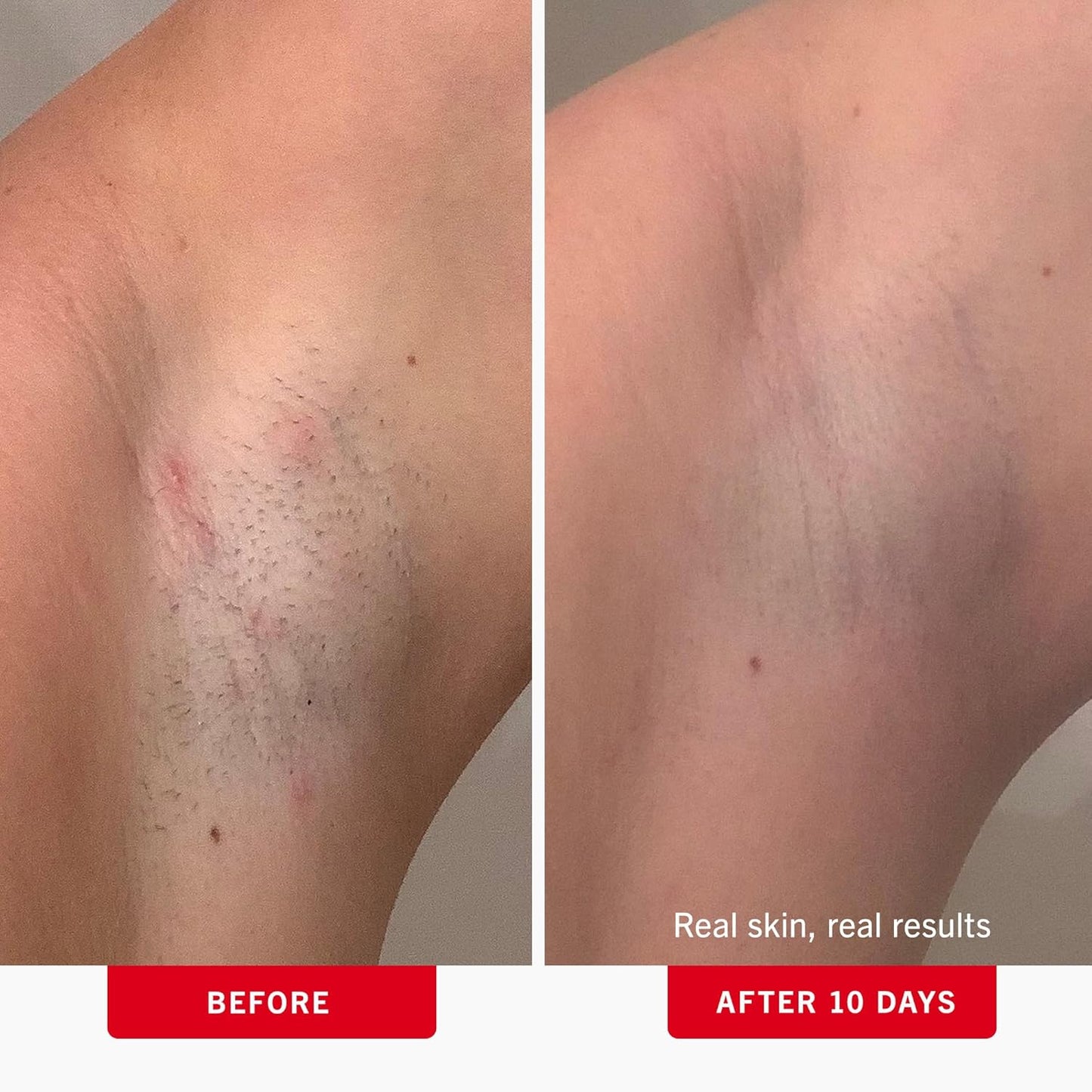 First Aid Beauty Ingrown Hair Pads – BHA & AHA Exfoliating Razor Bump Treatment