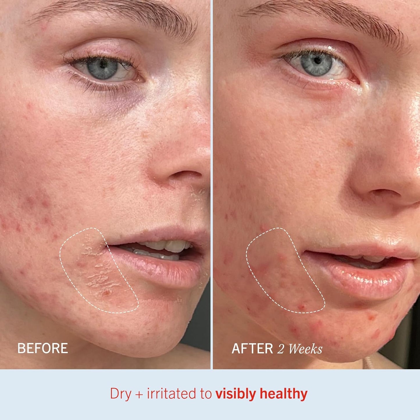 First Aid Beauty Ultra Repair Cream – Intense Hydration & Skin Barrier Support