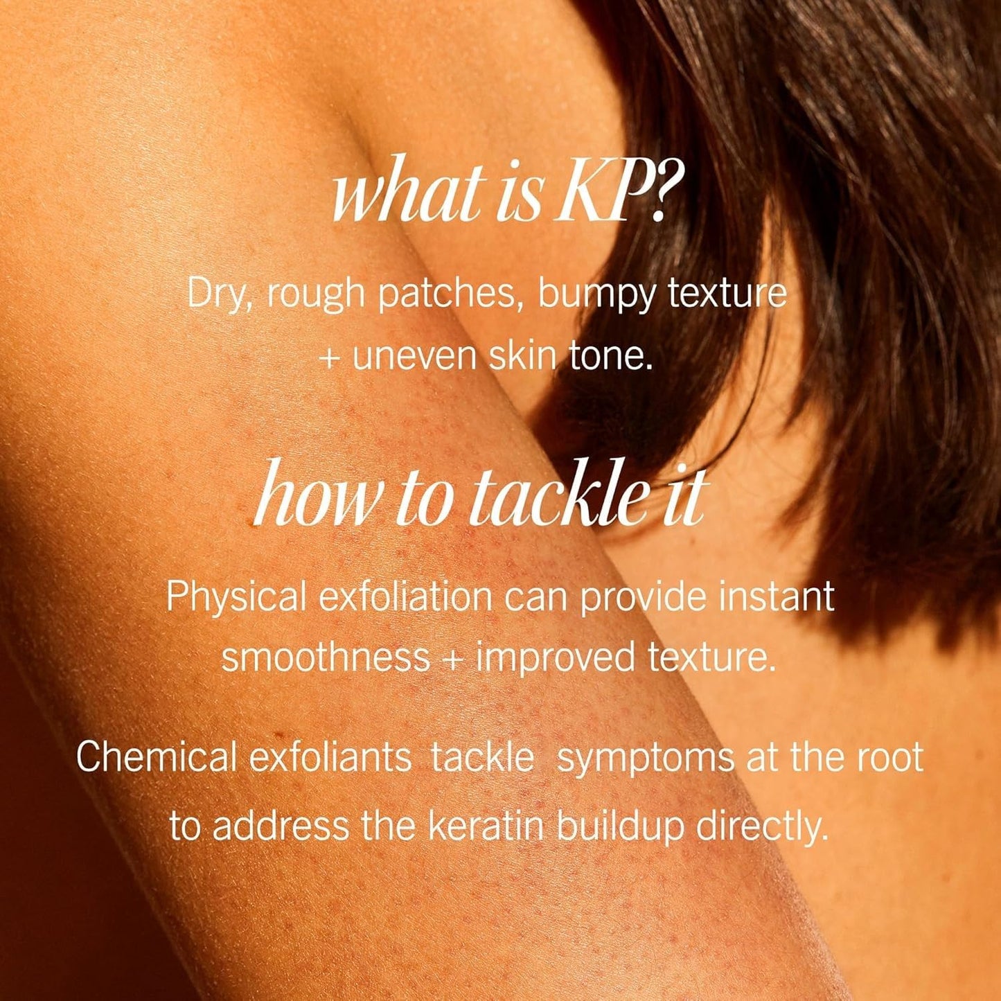 First Aid Beauty KP Bump Eraser Body Scrub – 10% AHA Exfoliator for Smooth Skin