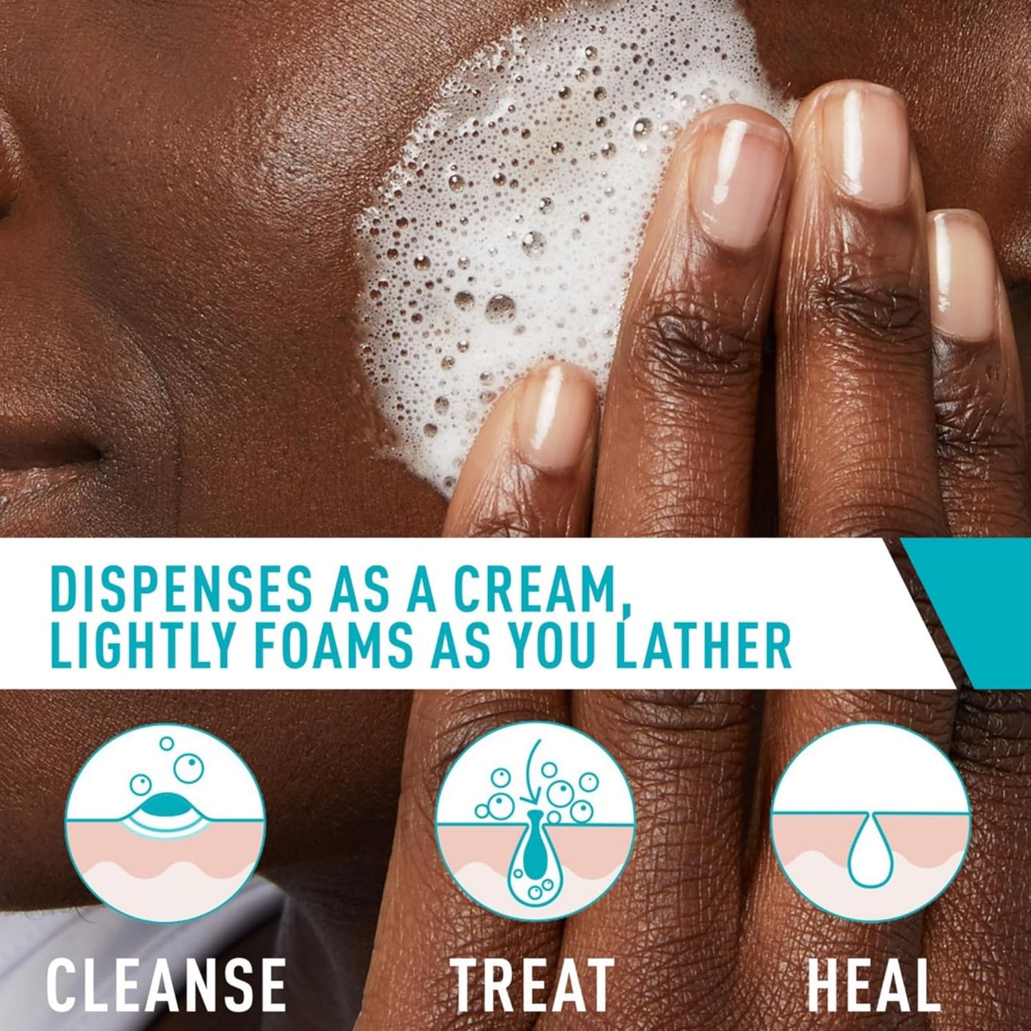 CeraVe Acne Foaming Cream Cleanser with 4% Benzoyl Peroxide & Hyaluronic Acid – Gentle Daily Acne Face Wash for Clear, Hydrated Skin