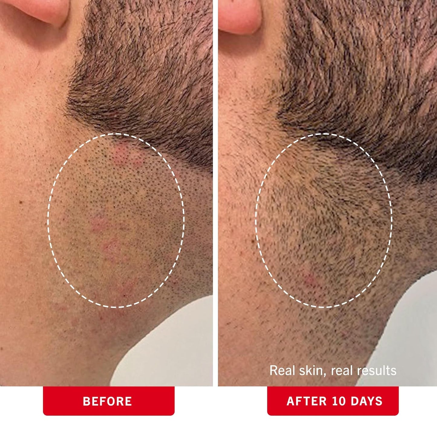 First Aid Beauty Ingrown Hair Pads – BHA & AHA Exfoliating Razor Bump Treatment