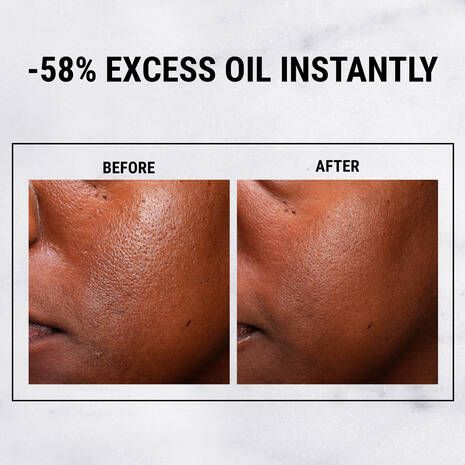 Ultra Pure High-Potency 5% Niacinamide Serum for Oily & Acne-Prone Skin – Shine Control & Pore Refining Formula